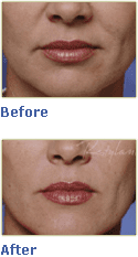Before & After Restylane in Ocala