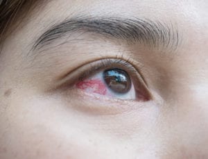 Dry Eye | Eye Conditions Ocala FL