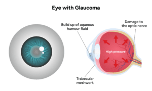 Diagram of an eye with glaucoma